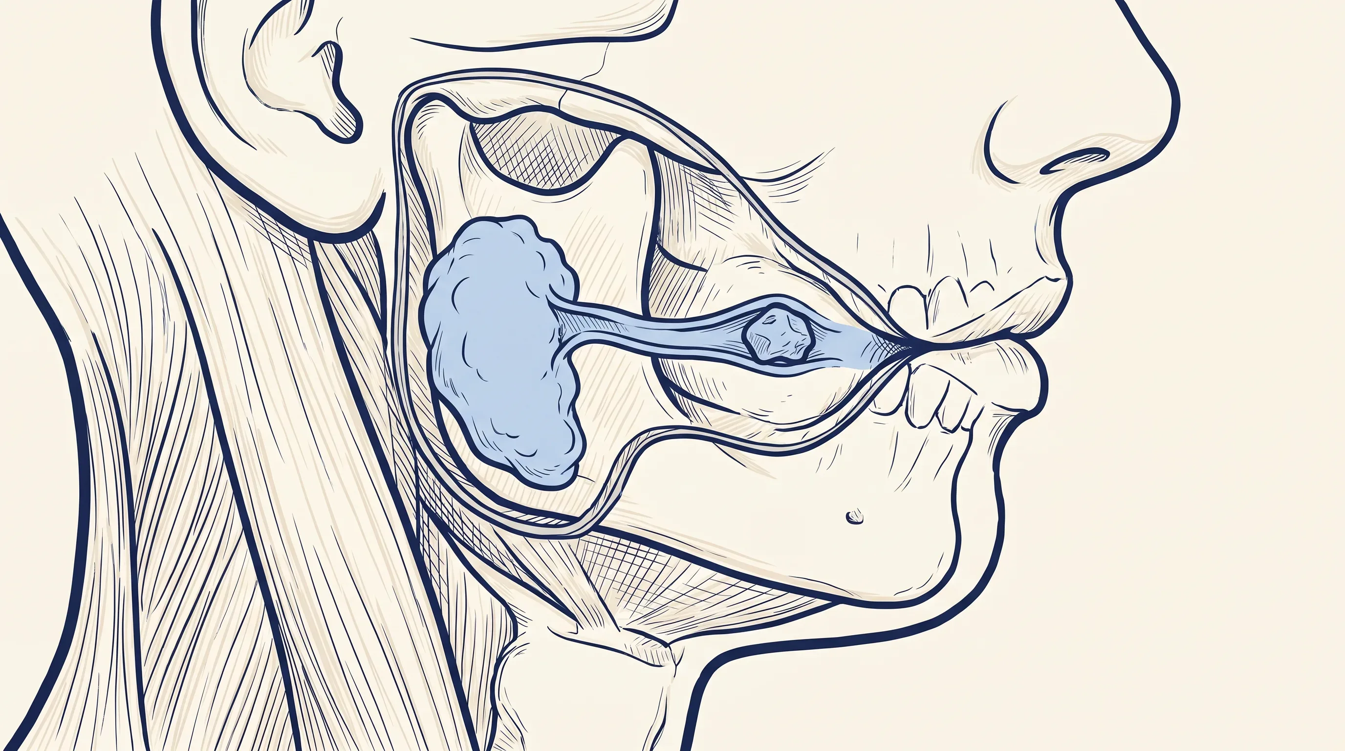 Cross-section illustration of the lower face showing a salivary gland, its duct, and a small stone lodged within the duct.