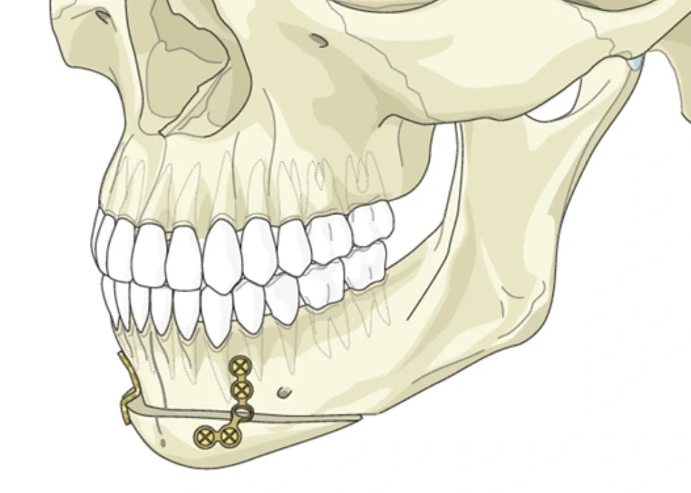 Side-profile illustration of the lower jaw with the chin segment cut and brought forward.
