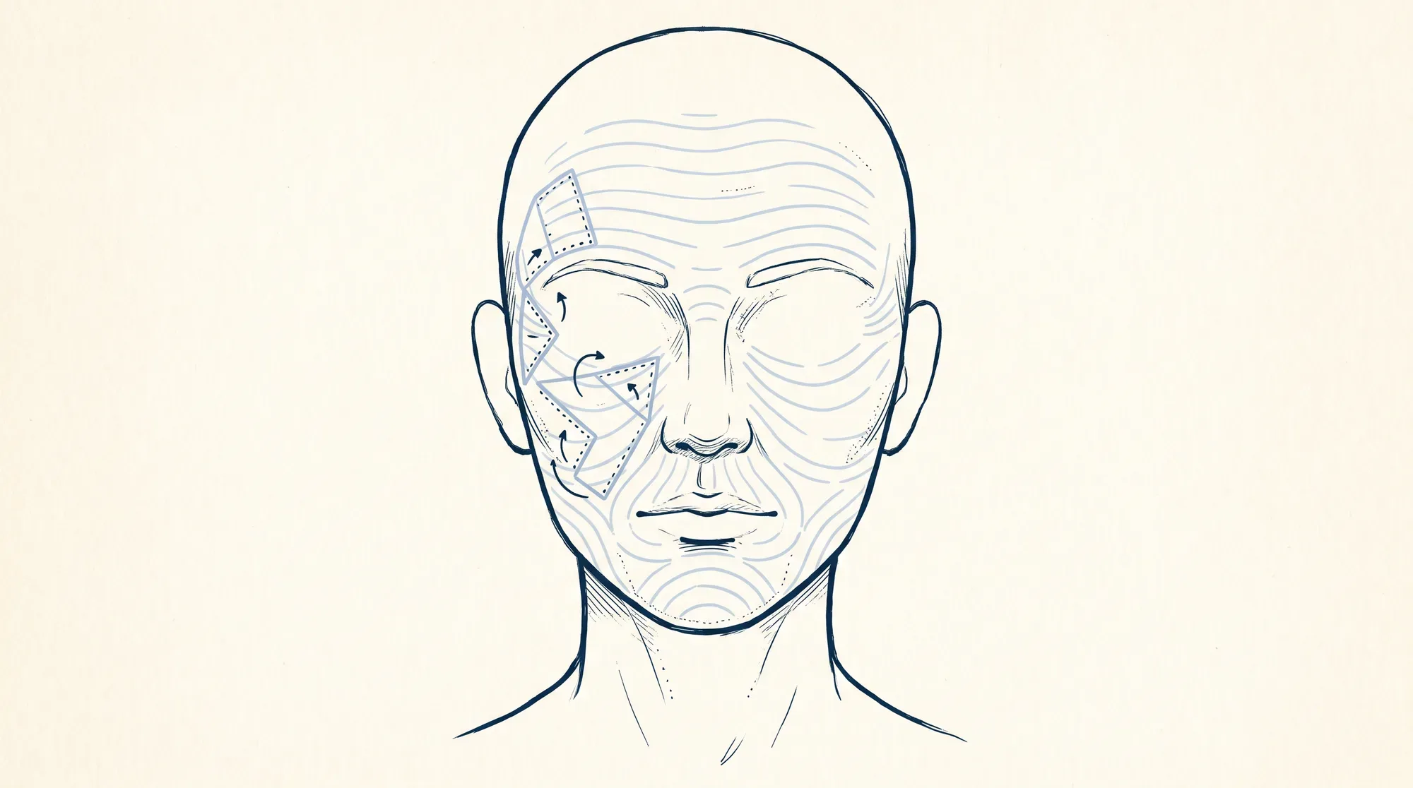 Illustration of a schematic face showing resting skin tension lines and local skin-flap incision designs overlaid across the skin surface.
