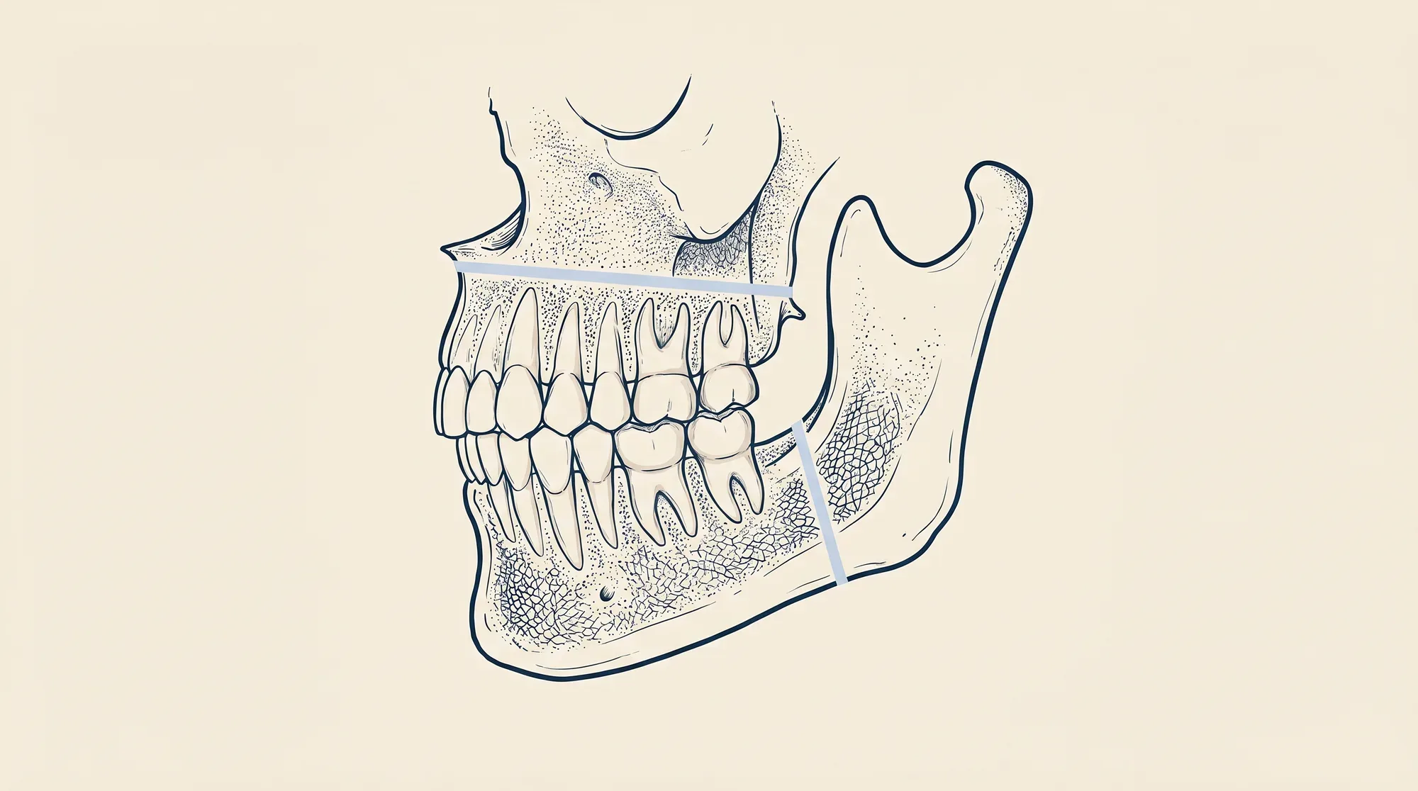 Illustration of the upper and lower jaws in profile, with the lower jaw divided at the angle and a segment repositioned.