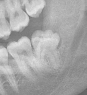 Panoramic X-ray of a distoangular wisdom tooth impaction