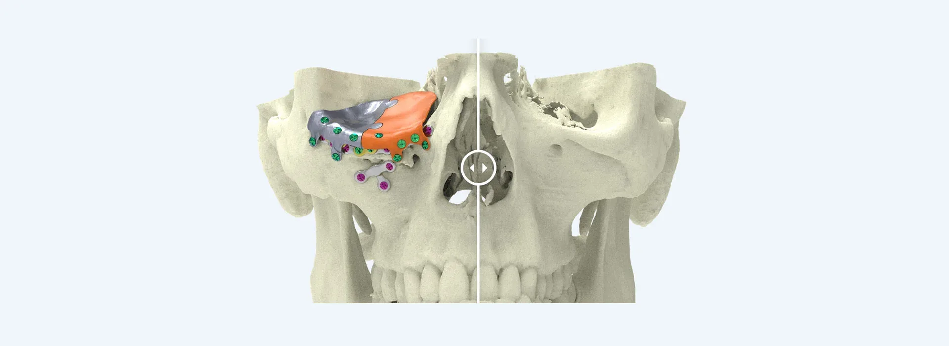 Cheekbone augmentation, facial surgery