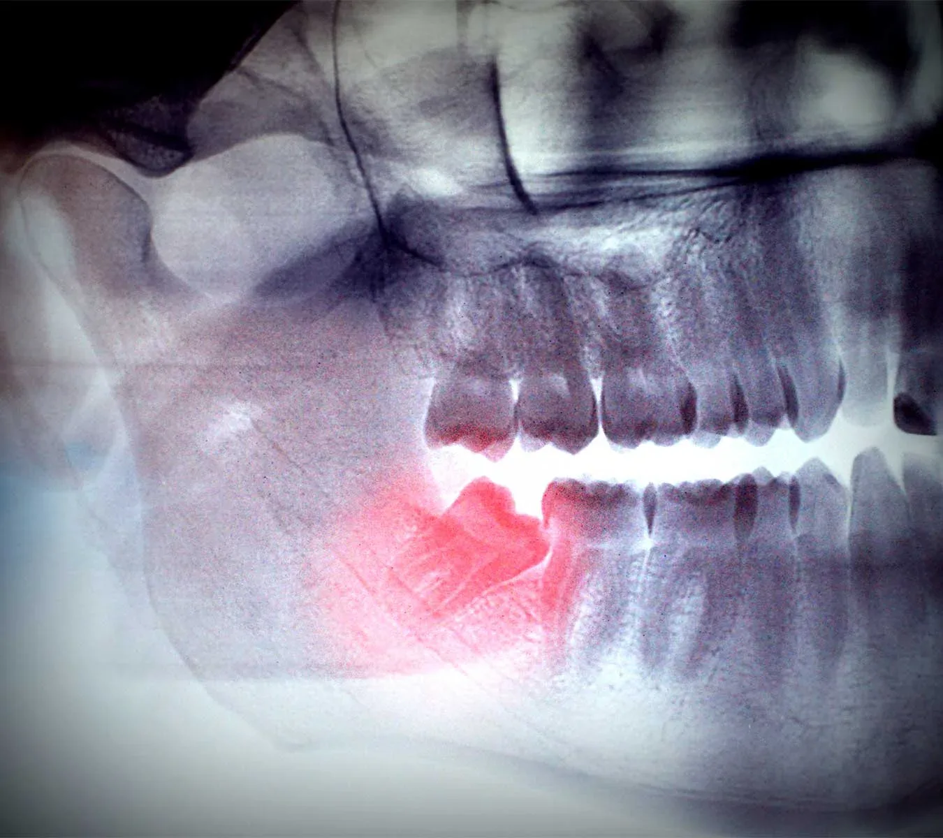 Wisdom tooth surgery, anatomical illustration