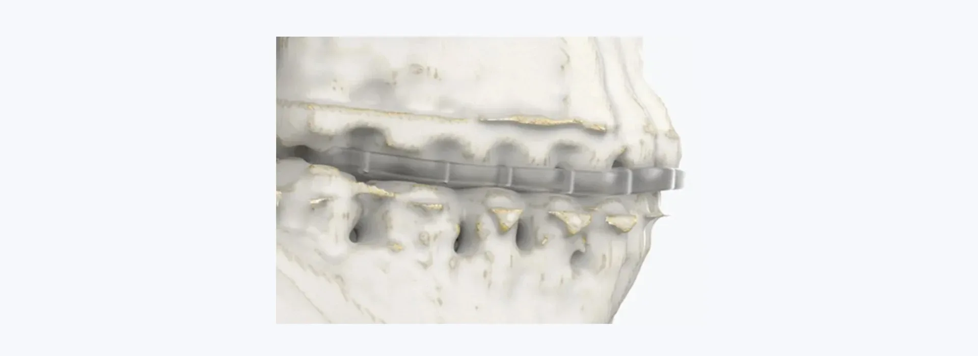 Chin augmentation (genioplasty) — clinical reference
