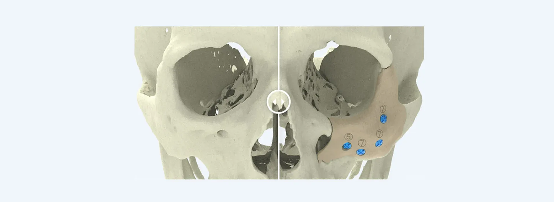 Virtual surgical planning — 3D imaging