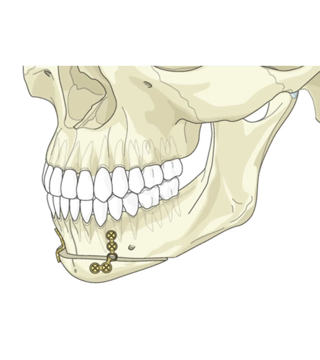 Chin augmentation (genioplasty) procedure
