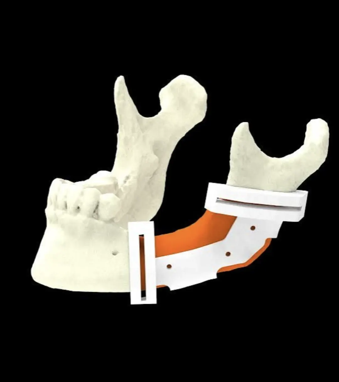 Virtual surgical planning procedure