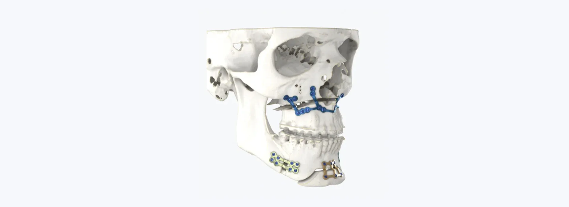 Jaw surgery for obstructive sleep apnoea