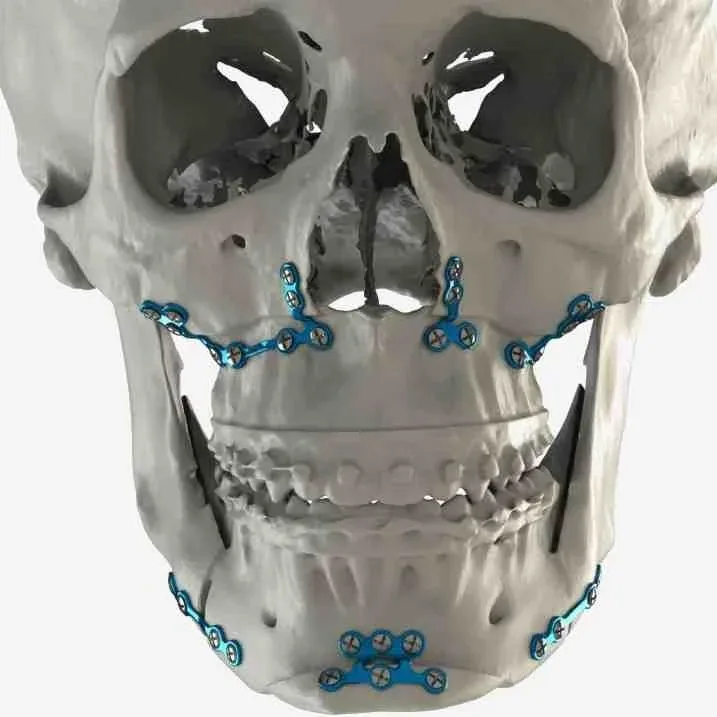 Orthognathic (corrective jaw) surgery — clinical reference