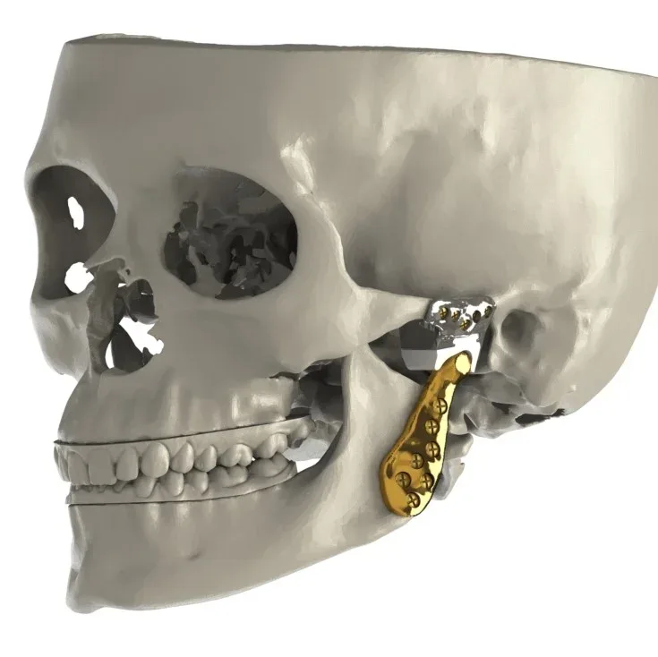 TMJ joint surgery, anatomical illustration