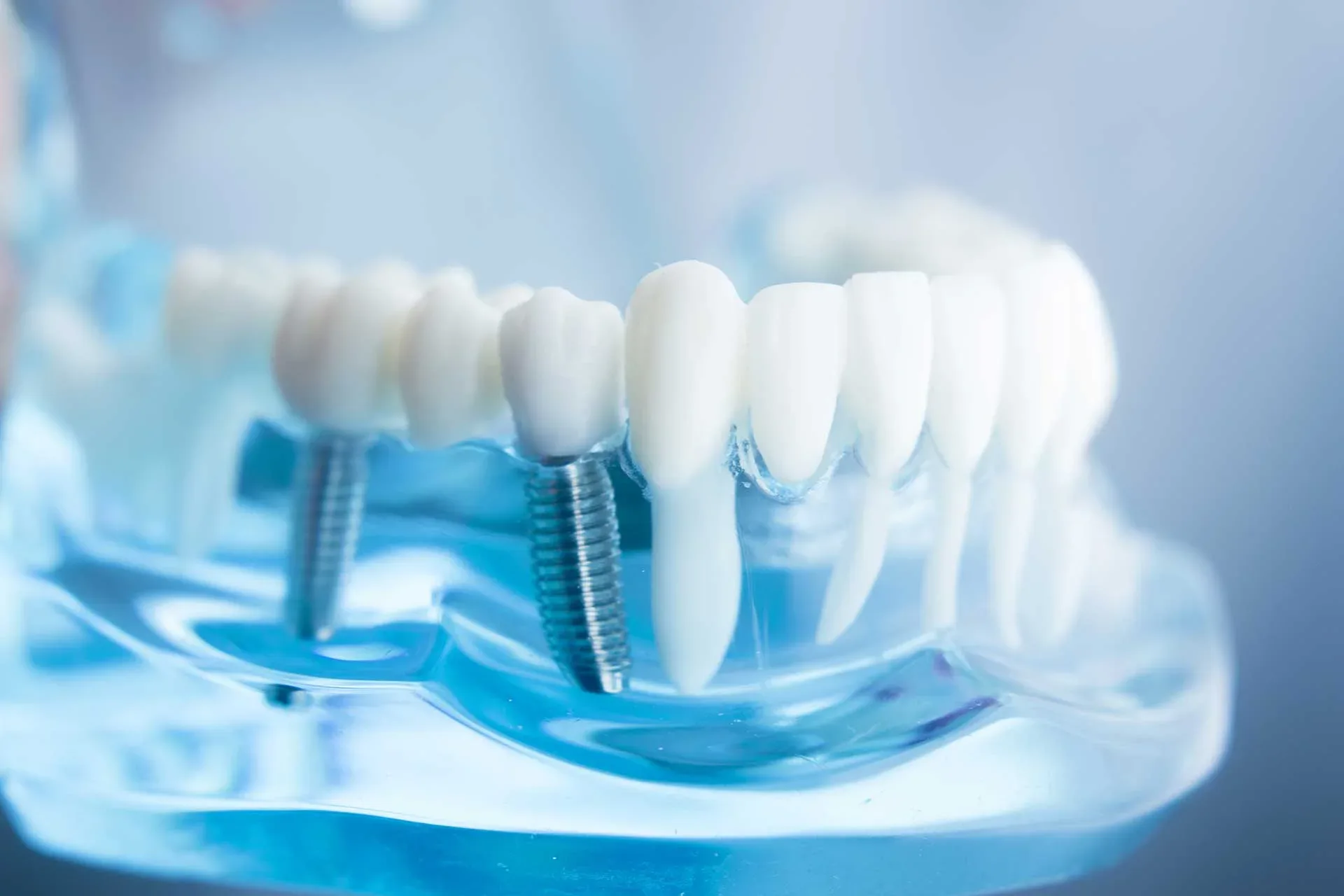 Dental and zygomatic implants — clinical close-up