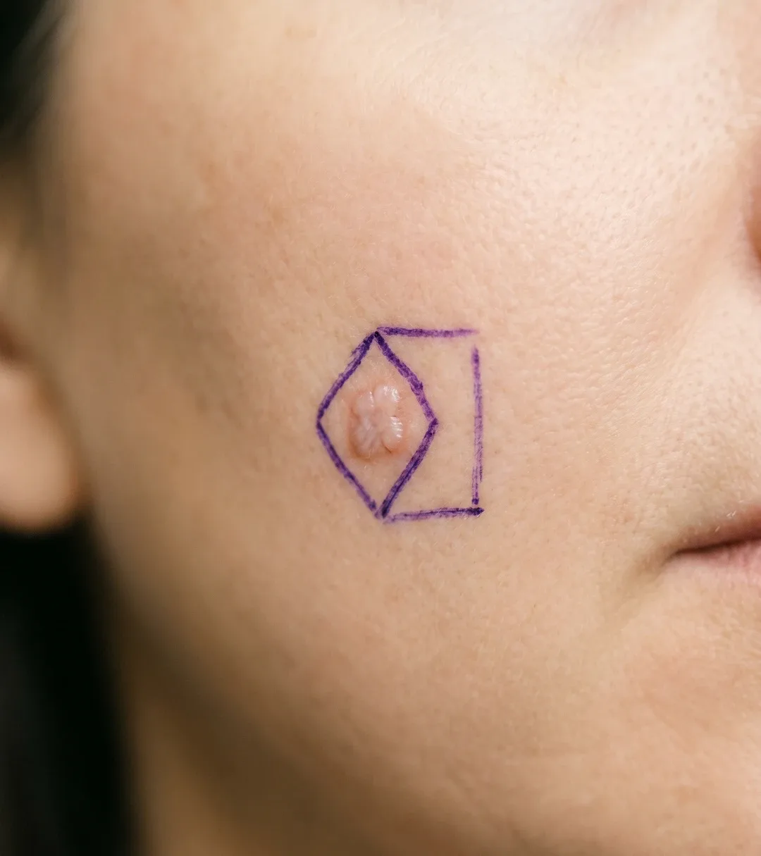 Close-up of healed facial skin around the nose and cheek after Mohs reconstruction, softly lit and anonymised.