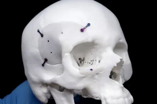 OMS Specialists surgeon performing facial trauma reconstruction in theatre