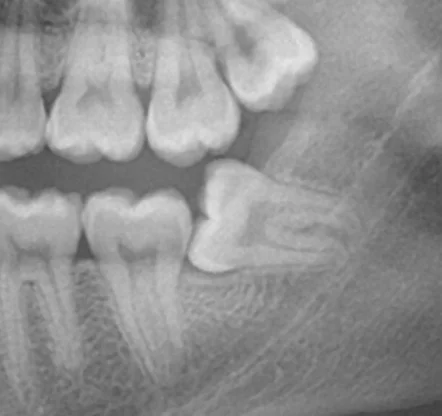 Panoramic X-ray of a horizontal wisdom tooth impaction
