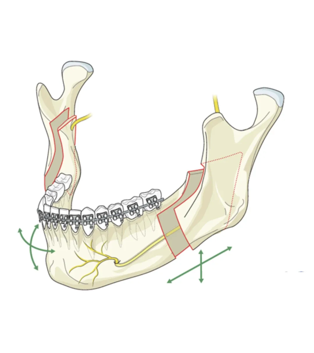 Anatomical jaw model showing corrective jaw surgery, with repositioned jaw segments secured by titanium fixation plates and screws