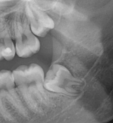 Panoramic X-ray of a mesioangular wisdom tooth impaction