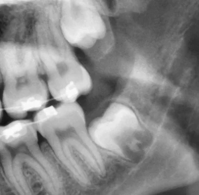 Panoramic X-ray of a vertical wisdom tooth impaction